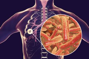 Fibrous-cavernous Pulmonary Tuberculosis And Close-up View Of My