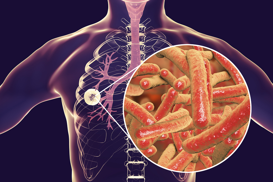 Fibrous-cavernous Pulmonary Tuberculosis And Close-up View Of My